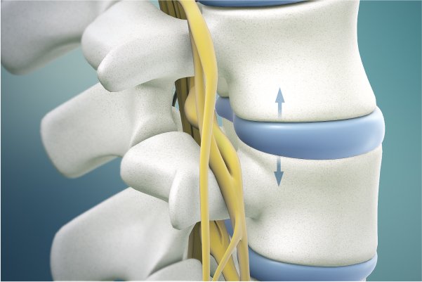 A team of experts performing open surgery for a disc-related spine issue.